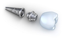 Implant parts | Dentist In Fircrest, WA | Emerson Dental