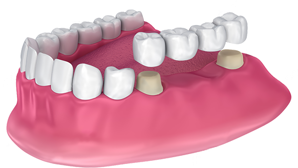 4-unit Bridge | Dentist In Fircrest, WA | Emerson Dental