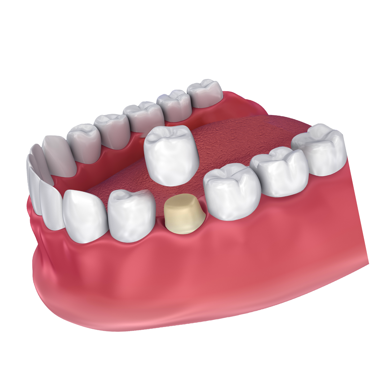 Crown | Dentist In Fircrest, WA | Emerson Dental