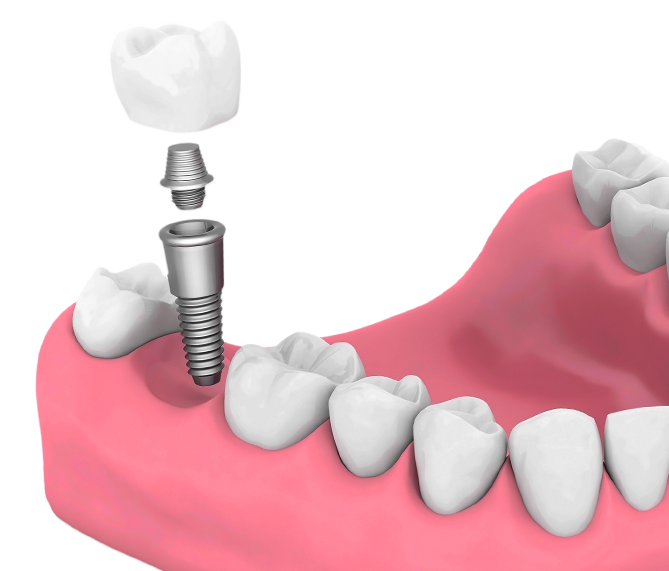 Implant | Dentist In Fircrest, WA | Emerson Dental