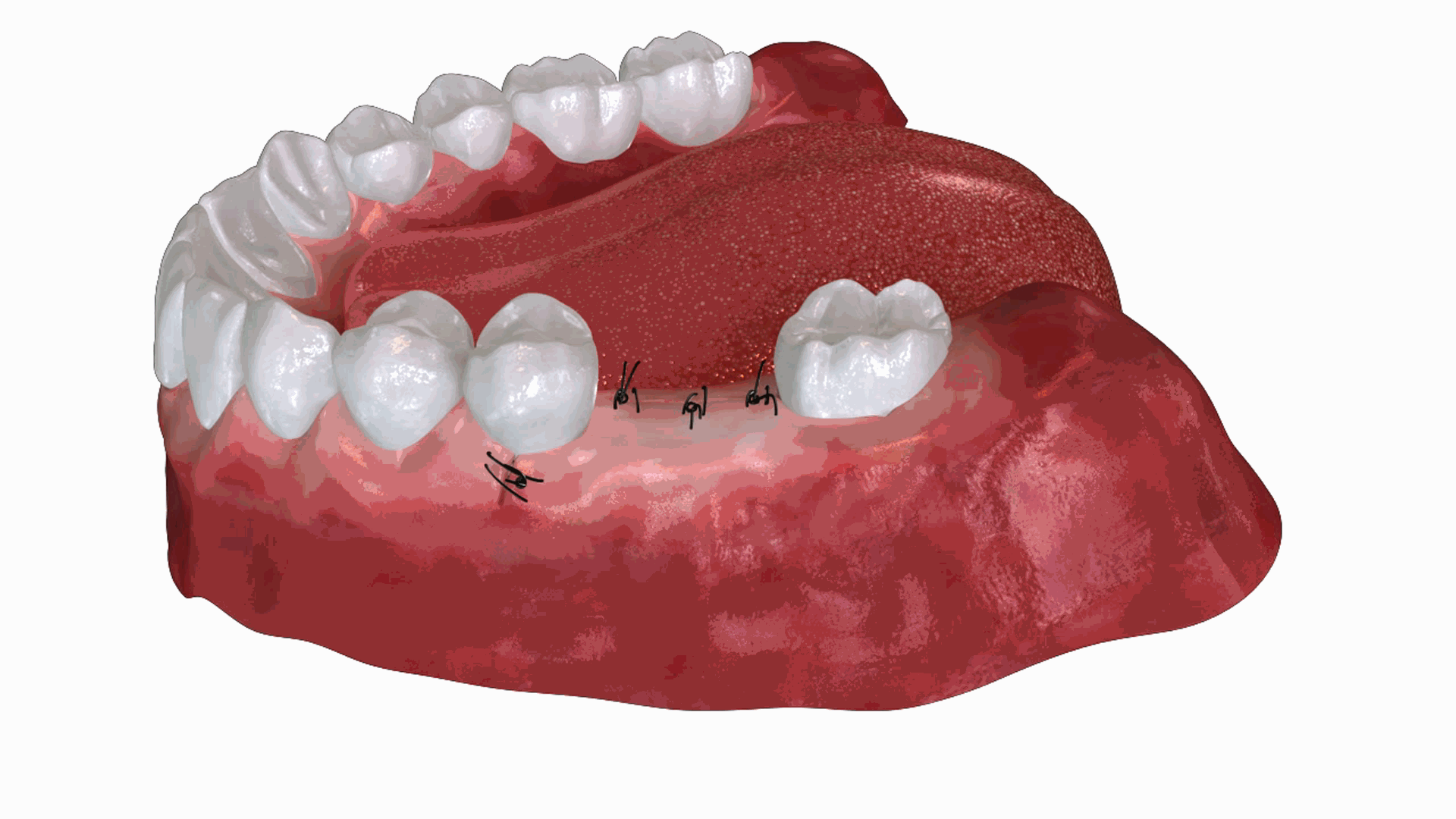 Healing | Dentist In Fircrest, WA | Emerson Dental
