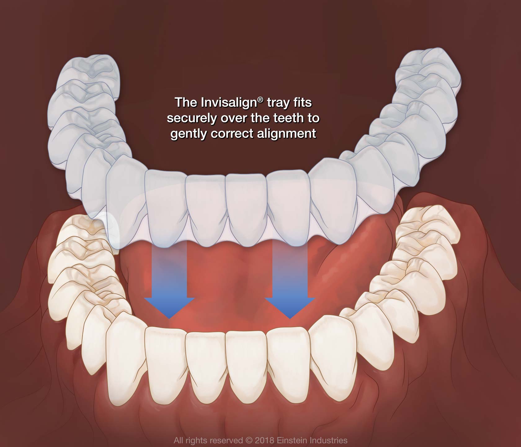 Invisalign | Dentist In Fircrest, WA | Emerson Dental